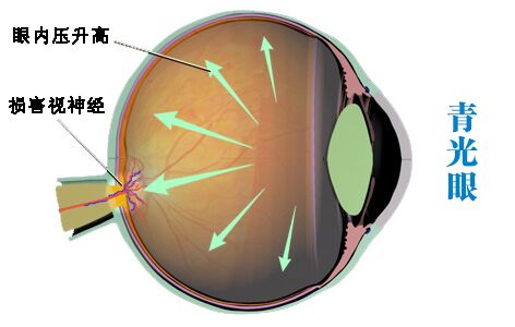 青光眼手术为什么可能加速白内障的形成