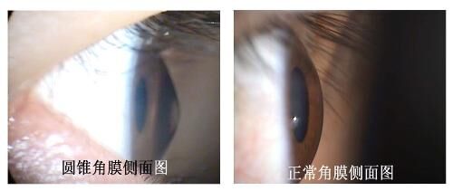 圆锥角膜治疗方法—RGP隐形眼镜可控制