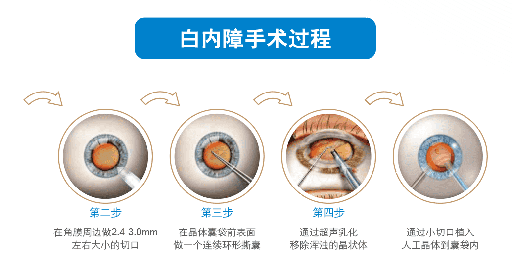 白内障手术费用差异解析：为何花费从几千到几万不等？